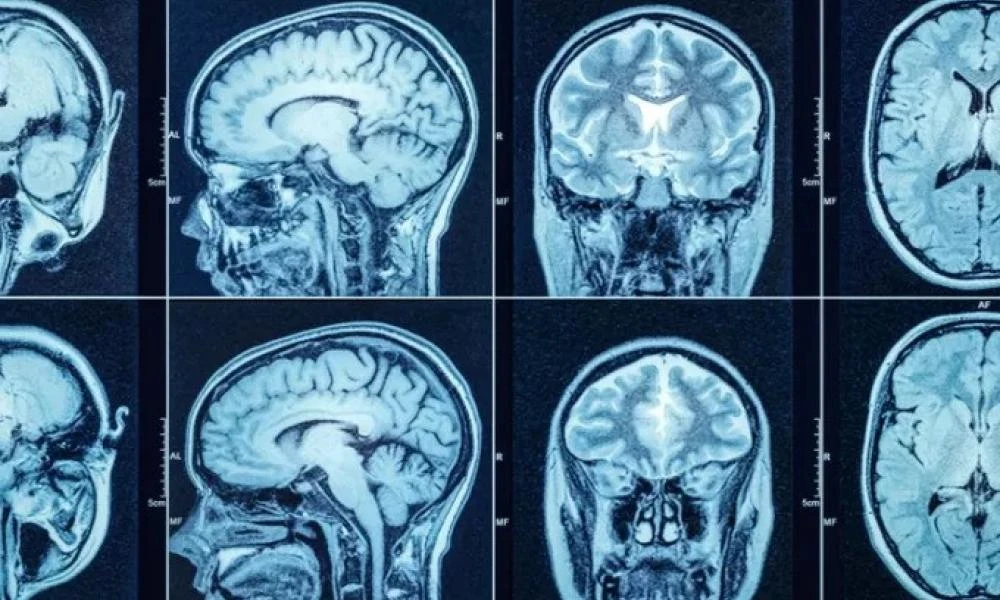 AI: Μπορεί να προβλέψει το ποσοστό επιβίωσης από την «πιο θανατηφόρα μορφή» καρκίνου του εγκεφάλου